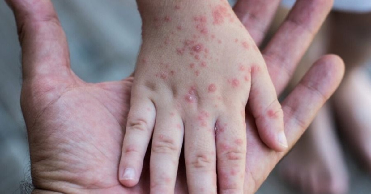 Sedes Tarija Confirma Primer Caso de Sarampión e Inicia Bloqueo Epidemiológico Urgente