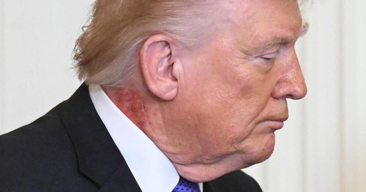 El médico de Donald Trump confirma causas de marcas rojas en su cuello