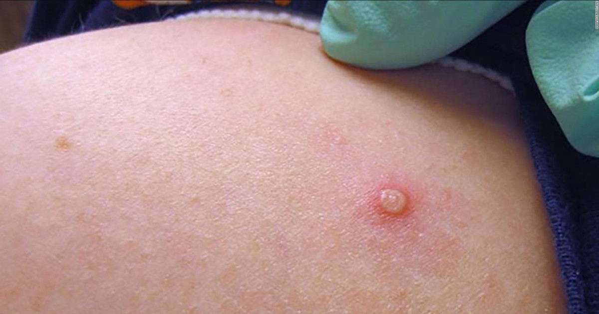 Ministerio confirma diez casos de viruela del mono en Bolivia en 2024